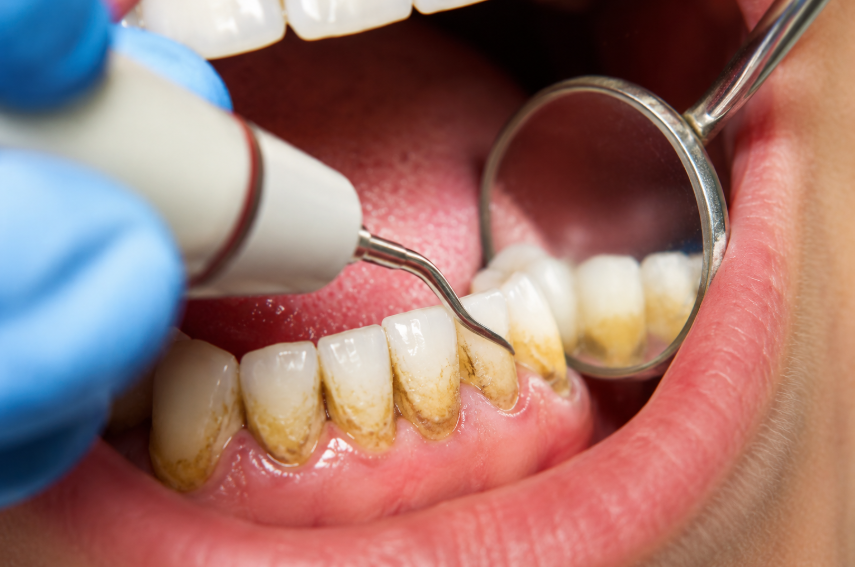 Affordable Dentist in Parkwood, CA