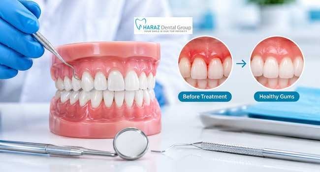 Gum Disease Treatment: What Are the Best Options for Healthy Gums?