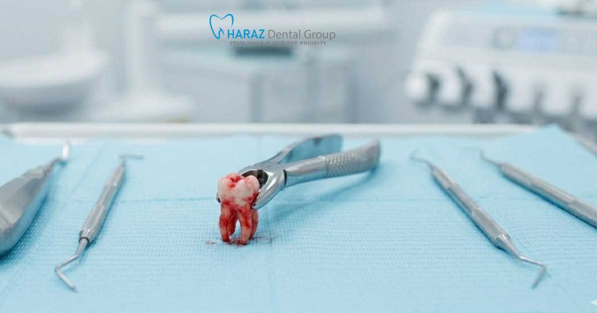 The Most Common Reasons Dentists Recommend Tooth Extractions