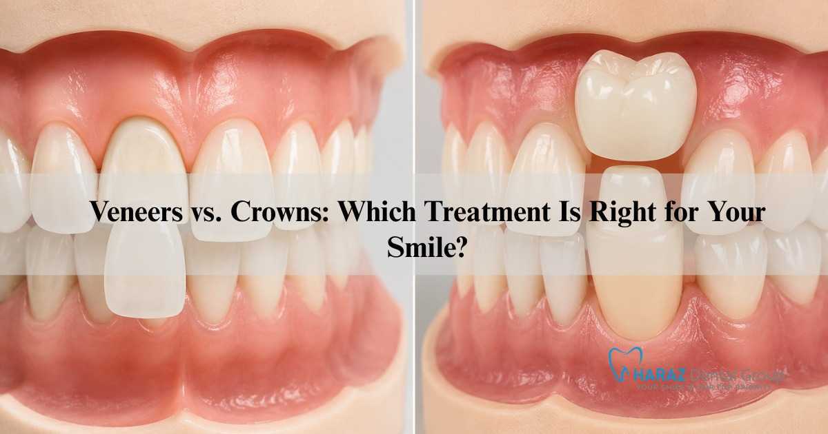 Veneers vs. Crowns: Which Treatment Is Right for Your Smile?